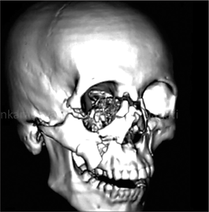 Cat 3D reconstruction of orbital fracture.