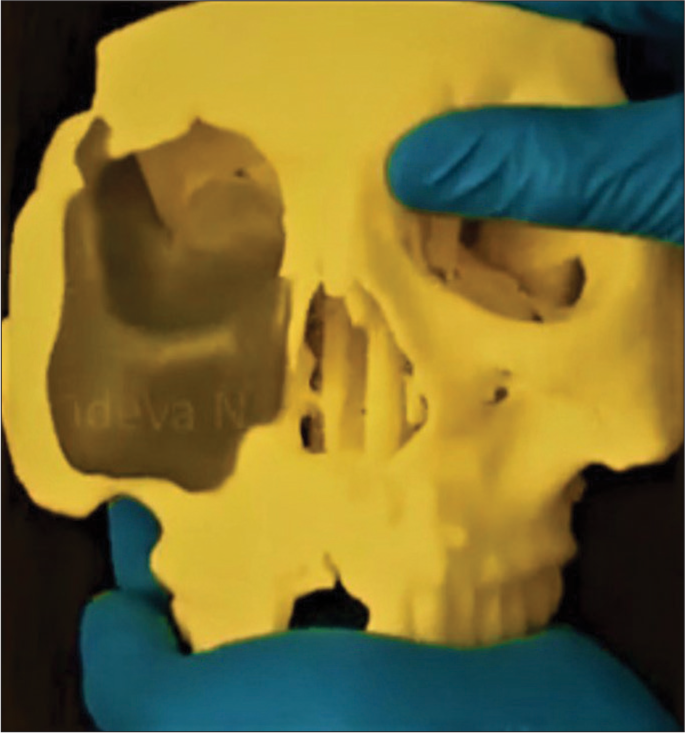 “Lock and key” type fitting by pre-operative mirroring from normal side.