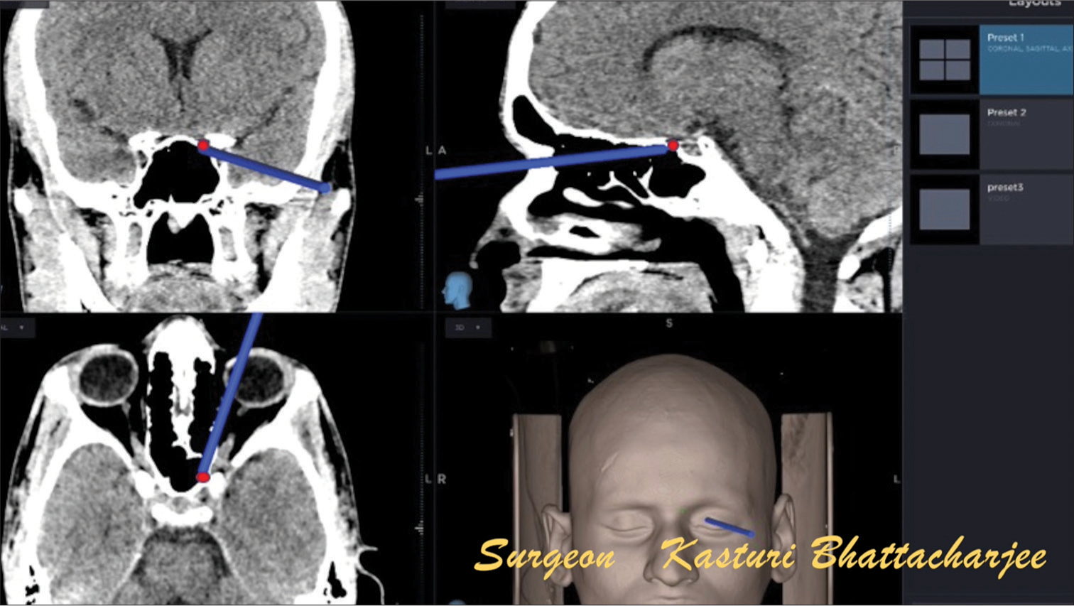 Application of global positioning system for precise intraoperative localization of lesion.