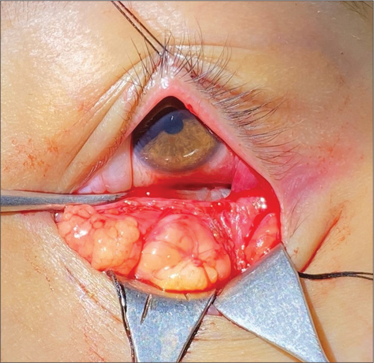 Image showing the medial, central, and lateral fat pads dissected at the time of lower lid transconjunctival blepharoplasty.