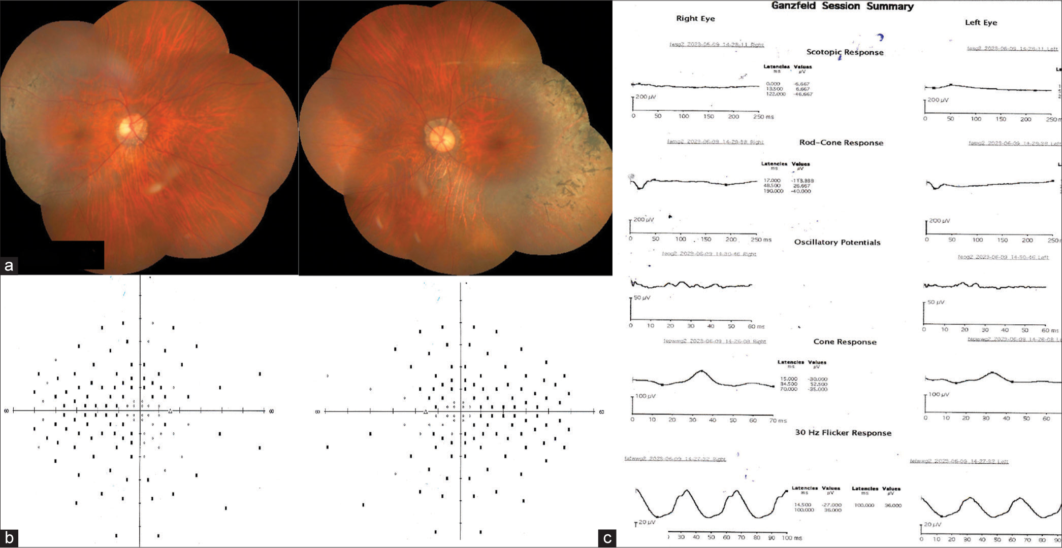 (a) Sectoral retinitis pigmentosa: bony spicules are seen in the temporal retina. The optic disc appears to be tilted with peripapillary atrophic changes. Diffuse tessellation of the fundus can be seen. (b) Center-sparing visual field loss can be seen extending to the periphery. (c) Almost flat waveform in scotopic test and reduced b-wave amplitude and increased implicit time in photopic 30 Hz flicker electroretinogram.