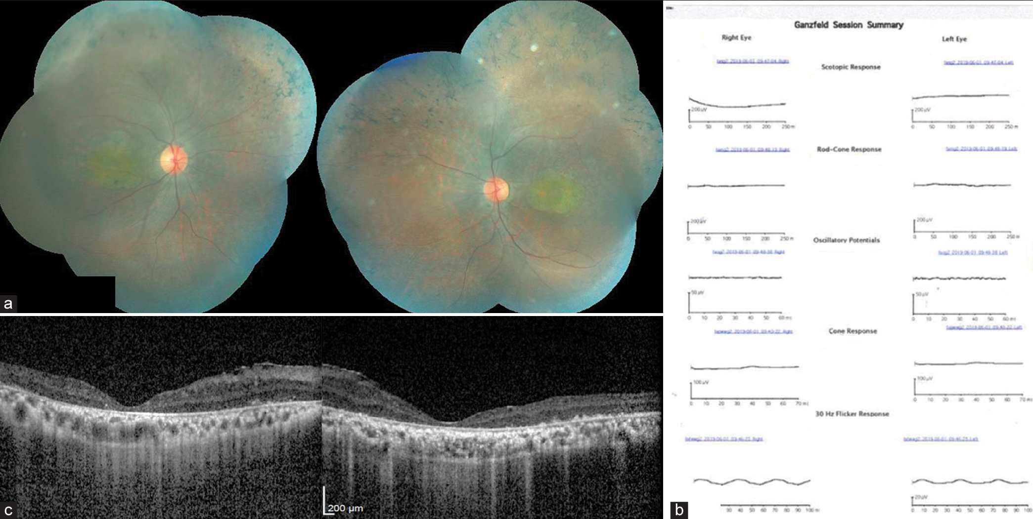 (a) Color fundus photography shows bony spicules in the periphery with maculopathy in both eyes. The optic disc and retinal vessels appear normal. (b) Electroretinogram report reveals a flat waveform in the scotopic and photopic test. (c) Epiretinal membrane can be seen on the inner retinal surface, foveal contour is maintained but there is diffuse foveal thinning and distinction of outer retinal layers cannot be made out on optical coherence tomography.