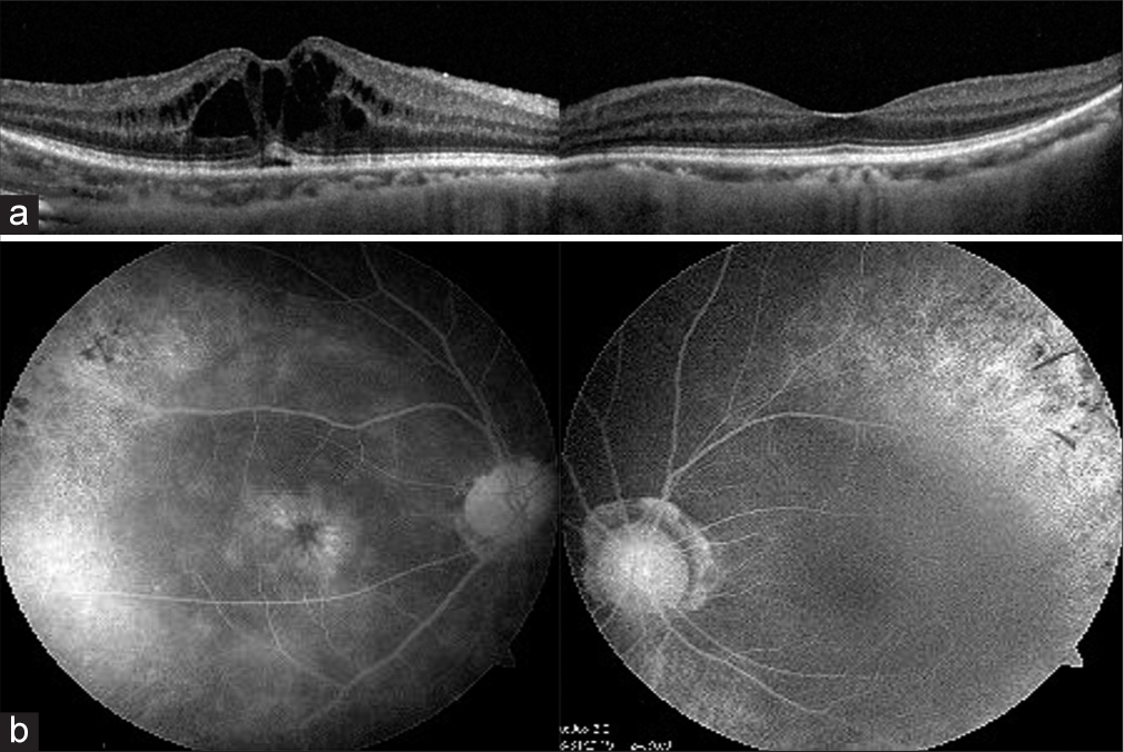 (a) Spectral-domain optical coherence tomography reveals the presence of cysts in the inner retinal layers and (b) shows the classic petaloid appearance of cystoid macular edema on angiography (Table 1, Case no. 5).