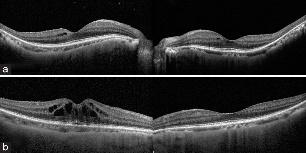 (a) Optical coherence tomography (OCT) scan taken on follow-up visit after 2 months of using topical dorzolamide shows a resolution of the cystoid macular edema. (b) However, a year later there is a recurrence of the macular edema as shown in the OCT image in.