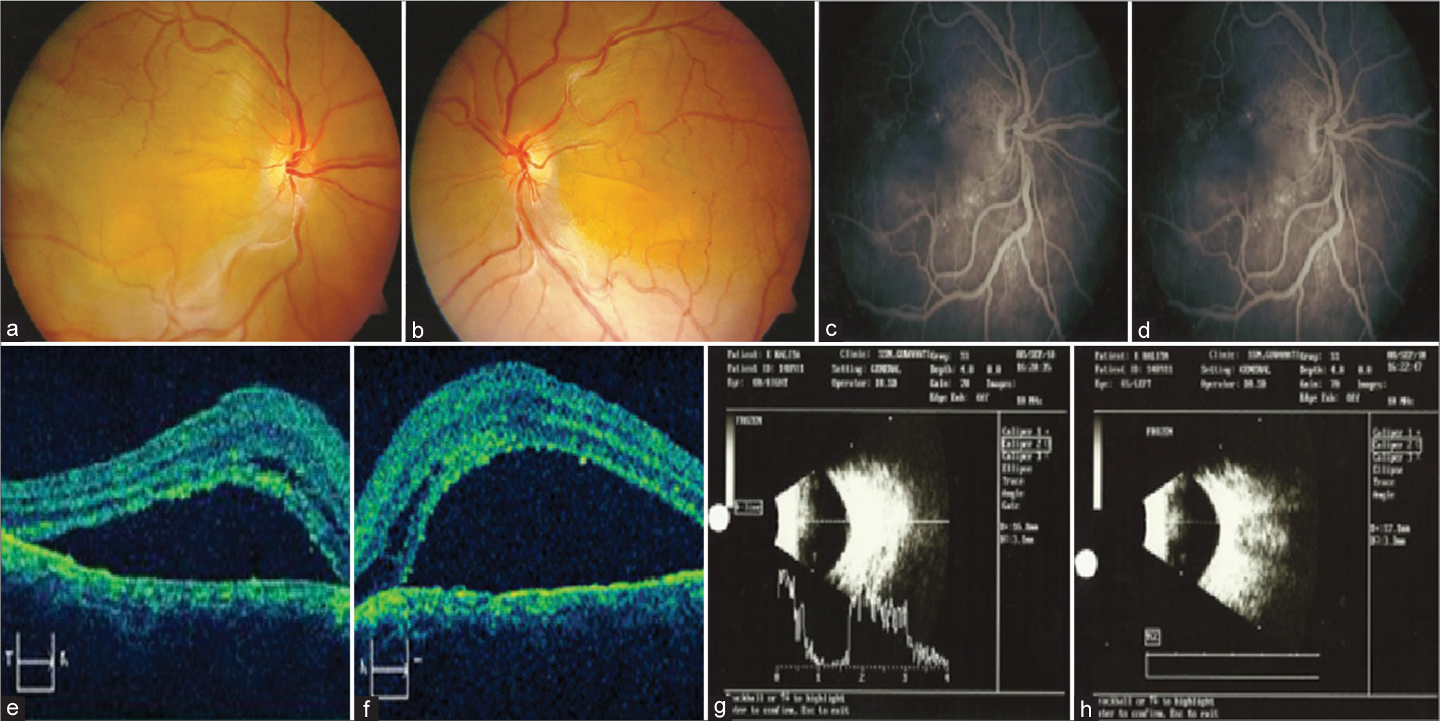 (a) Pre-treatment fundus photo right eye, (b) pre-treatment fundus photo left eye, (c) pre-treatment fundus fluorescein angiography (FFA) right eye, (d) pre-treatment FFA left eye, (e) pre-treatment optical coherence tomography (OCT) right eye, (f) pre-treatment OCT left eye, (g) pre-treatment ultrasonography (USG) B-Scan right eye, and (h) pre-treatment USG B-Scan left eye. Bright Scan (B-Scan).