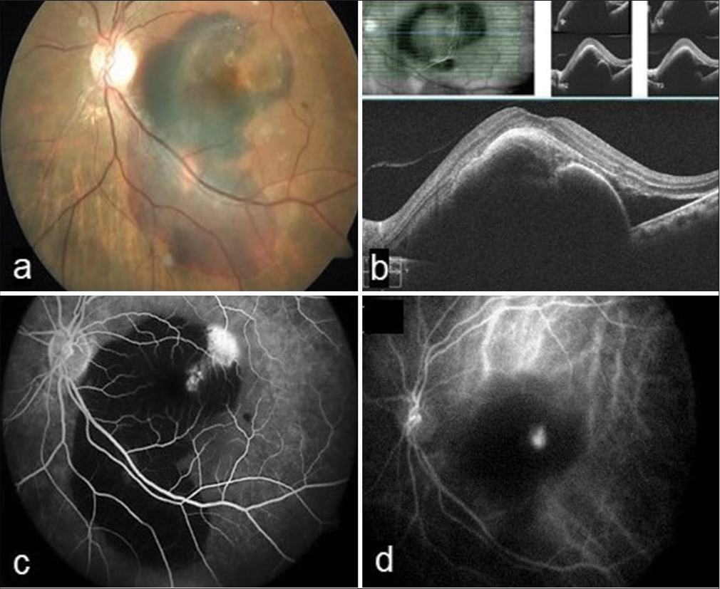 (a) A massive submacular hemorrhage. (b) Large fibrovascular pigment epithelium detachment and subretinal fluid. (c) Late leakage of an undetermined source superotemporal to the fovea. (d) A branching vascular network with active polyps.