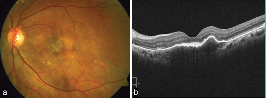 (a) Fundus photograph at three months follow-up shows significantly reduced submacular hemorrhage. (b) Optical coherence tomography macula shows flattened fibrovascular pigment epithelium detachment and resolved subretinal fluid.