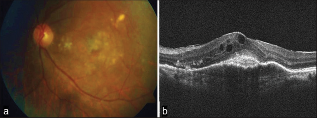 (a) Fundus photograph and optical coherence tomography (OCT) macula one month after the fifth dose of IVB shows scarred fibrovascular pigment epithelium detachment with ERM. (b) OCT of macula shows no subretinal fluid seen below the fovea, sub-foveal scar, SHRM sub-foveally. ERM: Epiretinal membrane, SHRM: subretinal hyper-reflective material.