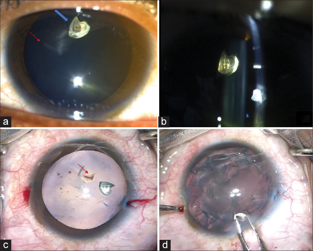 (a) Slit-lamp diffuse illumination image of the patient’s eye showing linear corneal scar of entry wound (red arrow) with an irregular foreign body embedded in the lens (blue arrow), (b) slit-lamp focal illumination/optical section image showing a foreign body embedded deep into the lens matter. Posterior capsule appears intact, (c) intraoperative image after trypan blue staining showing anterior capsular rupture tear (red arrow), and (d) viscoelastic and Kelman McPherson forceps assisted removal of the foreign body after nuclear matter emulsification.