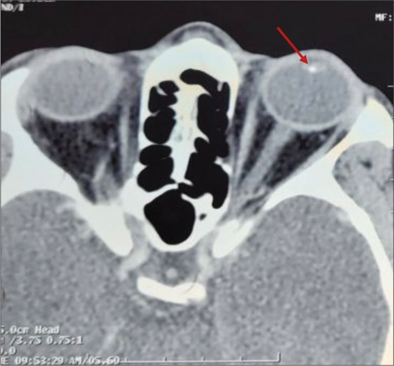 A computed tomography scan (axial section) of the orbit shows a hyperdense foreign body embedded in the lens matter (red arrow).