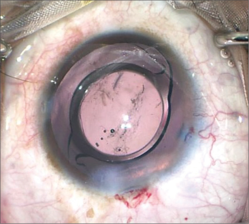 Intraoperative image with intraocular lens in situ.