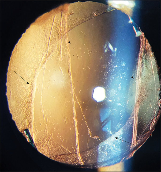 The follow-up image of sulcus implanted three-piece intraocular lens with the haptic in the sulcus and optics captured (arrow line) and the margin of the ruptured posterior capsule seen as two parallel lines (arrow head).