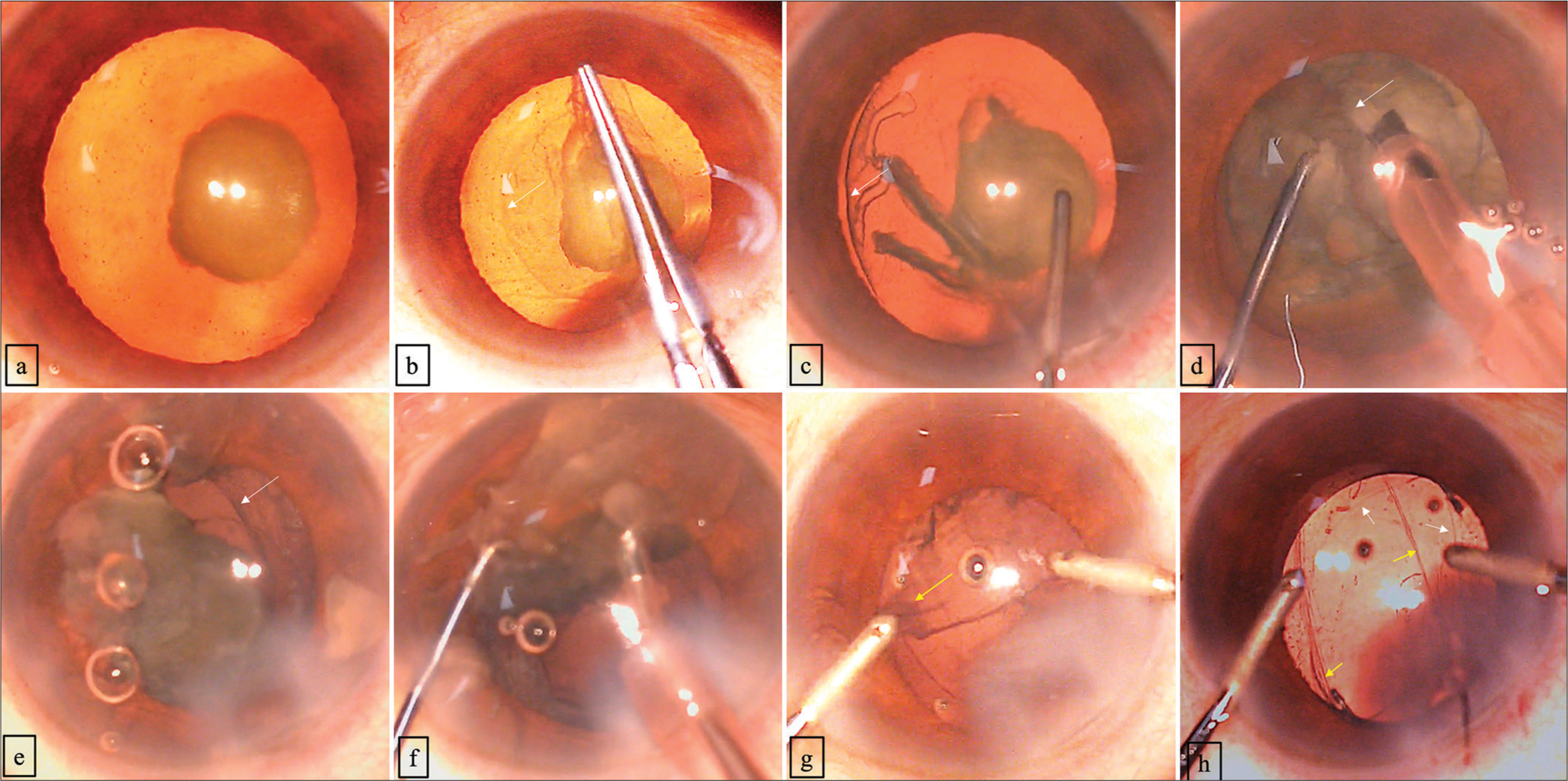 (a-h) The various important steps in the management of PPC with intraoperative PCR. (a) The nuclear opacity grade V with PPC without any pre-existing PCR. (b) The ideal size rhexis of approximately 5 mm. (c) The limited hydrodelineation without hydrodissection using a 23 G irrigation cannula. (d) The breaking of the nucleus into multiple quadrants without attempting to rotate the nucleus. (e) The visualization of the linear posterior capsular rupture indicated by the white arrow. (f) The completion of removing lens material by slow parameters phacoemulsification in the anterior chamber above the iris plane. (g) The removal of the cortical matter from the capsule. (h) The implantation of a three-piece IOL in the sulcus, with optic capture being done using the same I and A (irrigation aspiration cannula), the white arrow shows the margin of the anterior capsule and the yellow arrow shows the margin of the linear posterior capsular rent.