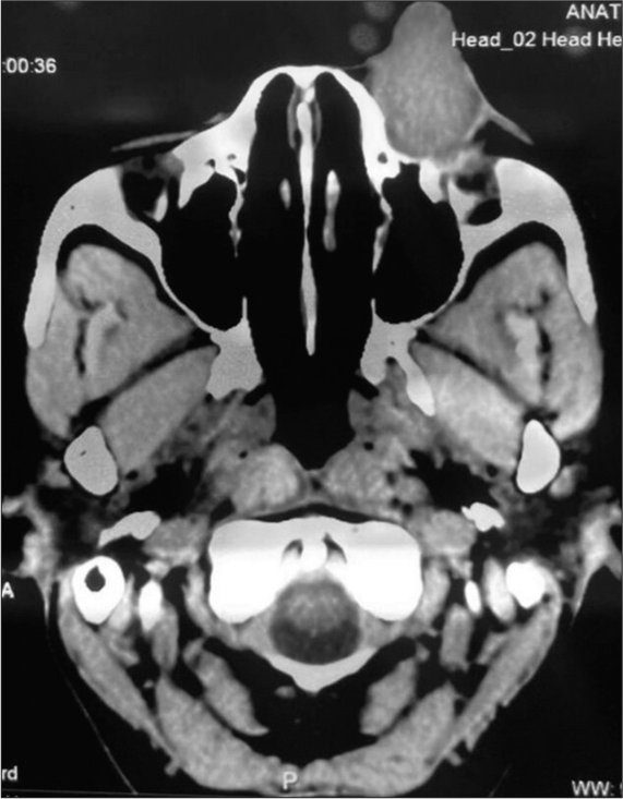 Axial computed tomography scan showing a large exophytic mass without bony erosion.