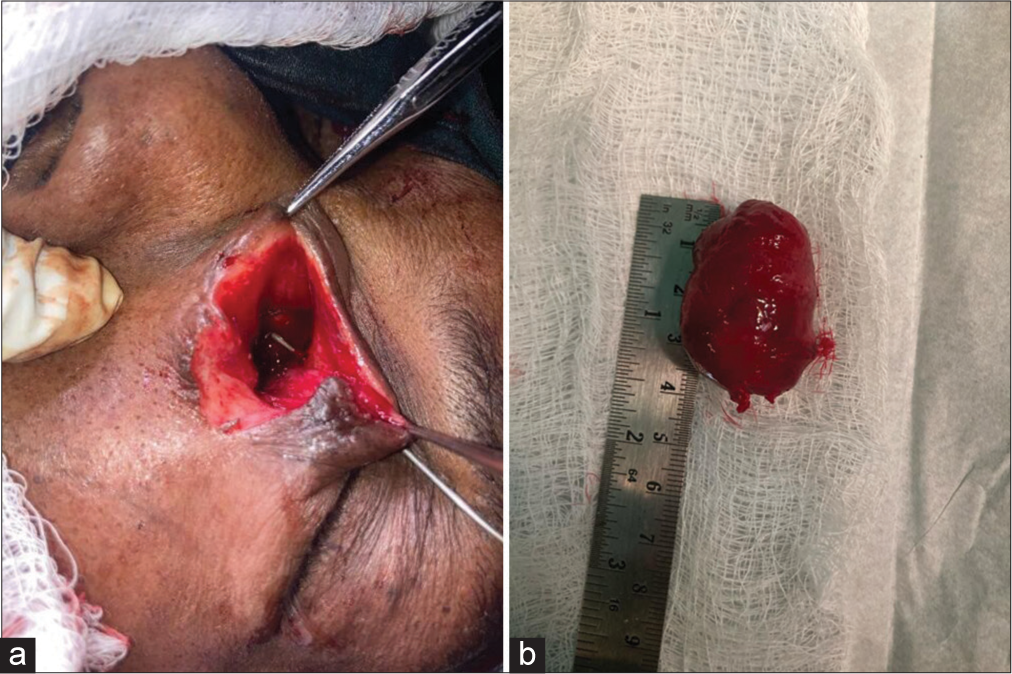 (a) A dead space seen following the removal of the mass with lacrimal probes exposed on passing them through the superior and inferior punta. (b) A well-circumscribed encapsulated mass measuring 3.7 cm by 1 cm.