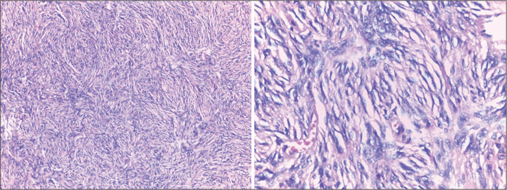 (a) Photomicrograph (hematoxylin and eosin) ×100 magnification showing prominent storiform pattern of bland spindles cells. (b) (×400 magnification) showing bland spindle cells with vesicular nuclei in storiform pattern and multinucleate giant cells.