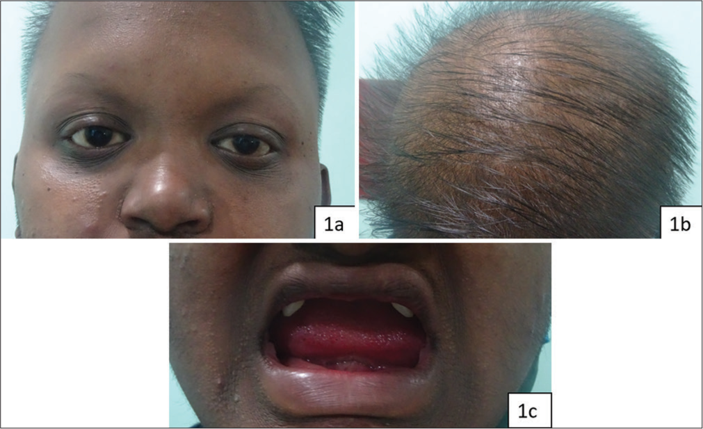 (a-c) Typical features of X-linked hypohidrotic ectodermal dysplasia (HED) in the index patient. (a) Patient with features of HED (sparse eyelashes and eyebrows). (b) Patient with features of HED (dry, brittle, and sparse hair). (c) Patient with features of HED (hypodontia with wide-spaced pointed teeth).