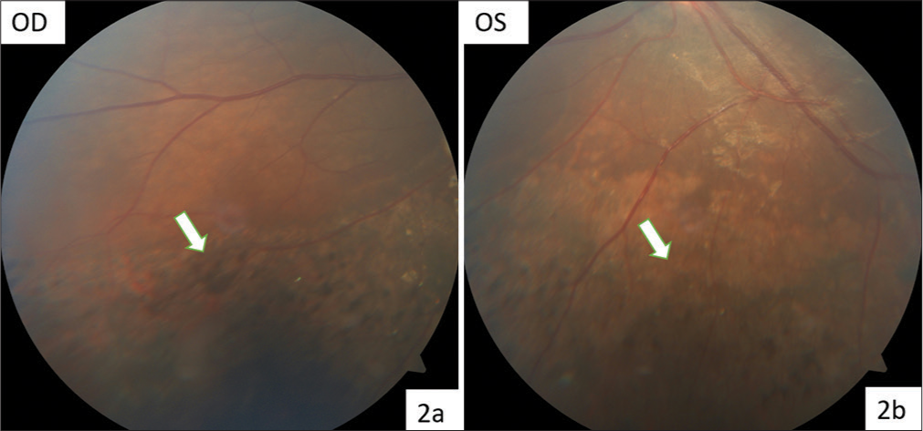 (a and b) Color fundus photograph (OU) shows multiple chorioretinal atrophic patches with hyperpigmentation (white arrow).