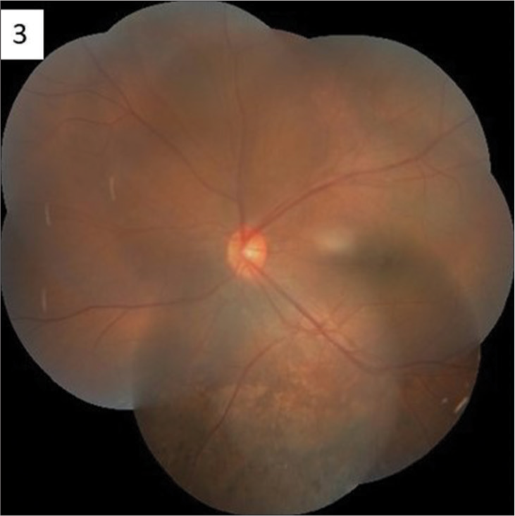 Montage photograph showing normal disc features along with chorioretinal lesion in periphery in the left eye (OS).