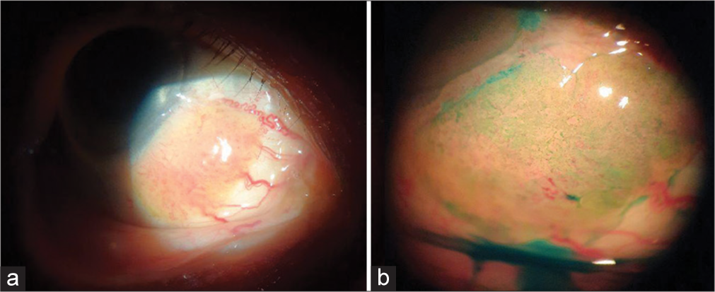 Before initiation of 5-fluorouracil treatment (a) Slit-lamp examination showed a 8 × 5.5 mm pinkish fleshy lesion with distinct borders and feeder vessels, encroaching the limbus, (b) lesion stained with Lissamine green.