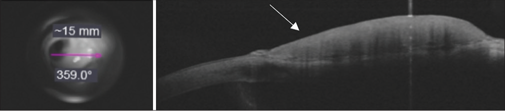 Before initiation of 5-fluorouracil treatment, en face projection of OCT signal from cornea to conjunctiva (pink arrow). Anterior segment optical coherence tomography (OCT) of lesion showing a zone of hyperreflectivity and thickened epithelium corresponding to the conjunctival lesion (white arrow).