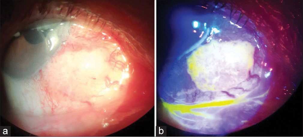 After 2 weeks of treatment of topical 5-fluorouracil, (a) Decrease in size of lesion noted. (b) Uptake on the lesion with fluorescein dye.