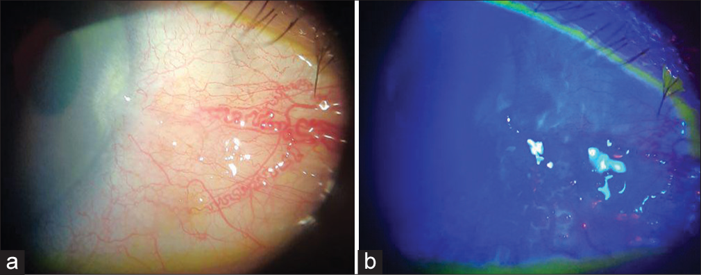 After completion of 1 cycle of treatment, (a) Noted a gelatinous lesion with feeder vessels encroaching limbus. (b) Punctate staining of the lesion with fluorescein dye.