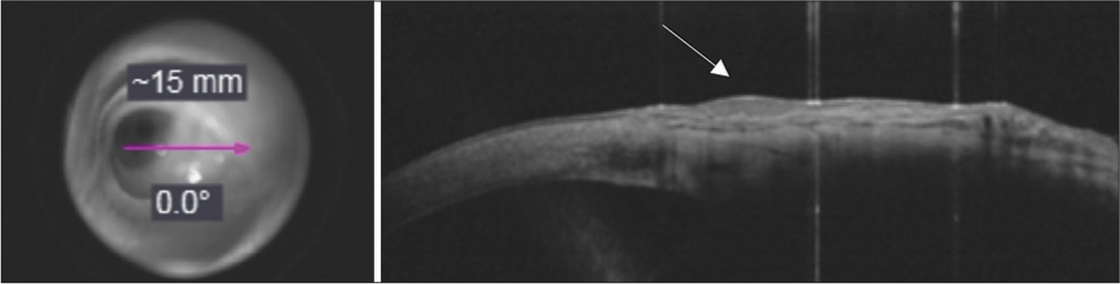 After completion of 1 cycle of treatment, en face projection of OCT signal from cornea to conjunctiva (pink arrow). Anterior segment optical coherence tomography (OCT) of lesion showing a decreased zone of hyperreflectivity (white arrow).