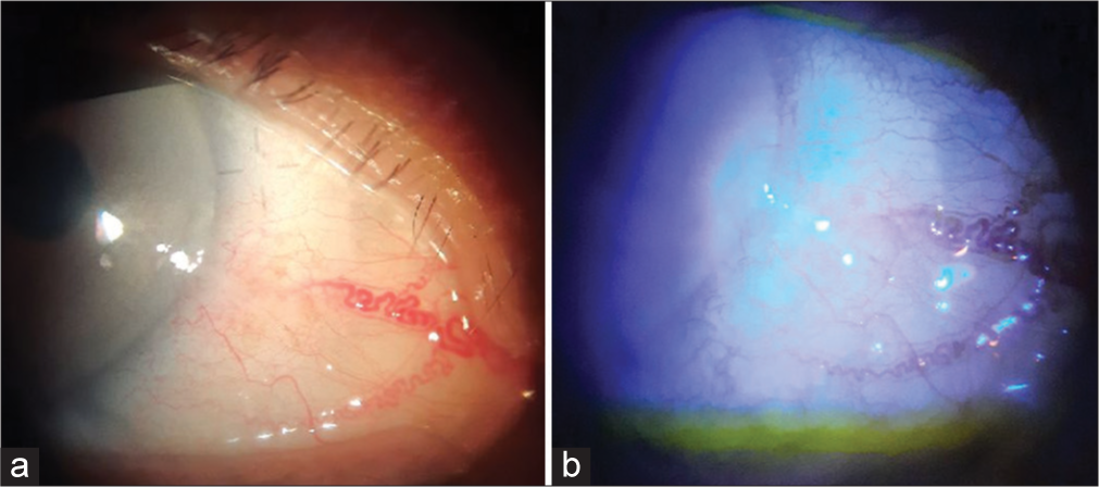 After completion of 2 cycles of treatment, (a) No gross lesion seen but still with feeder vessels. (b) Minimal punctate staining of the lesion with fluorescein dye.