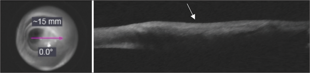 After completion of two cycles of treatment, en face projection of OCT signal from cornea to conjunctiva (pink arrow). Anterior segment optical coherence tomography (OCT) of lesion showing a decreased zone of hyperreflectivity on the conjunctiva (white arrow).