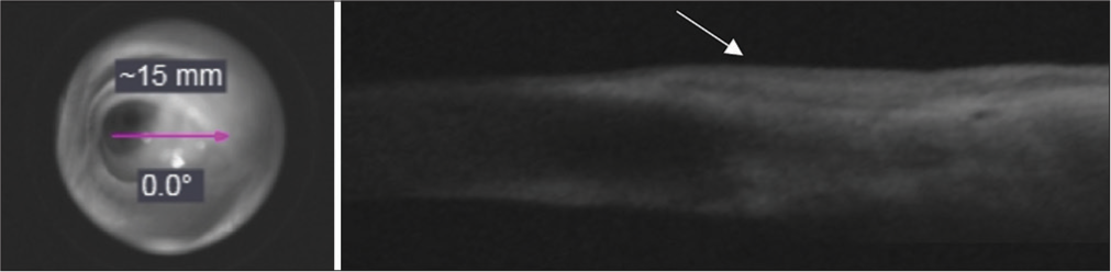 After completion of three cycle of treatment, en face projection of OCT signal from cornea to conjunctiva (pink arrow). Anterior segment optical coherence tomography (OCT) of lesion still showing a zone of hyperreflectivity on the conjunctiva (white arrow).