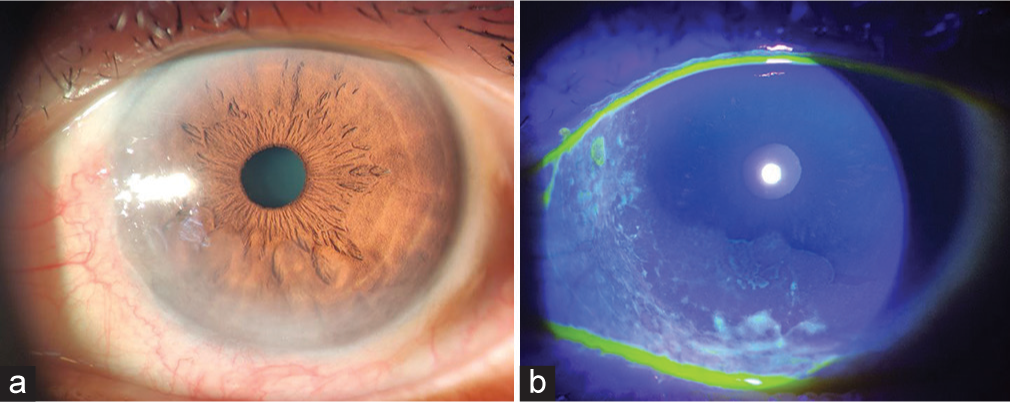 Before initiation of 5-fluorouracil treatment (a) Slit lamp showed a fleshy mass on the nasal bulbar conjunctiva. (b) Dye uptake on cornea noted.