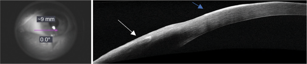 Before initiation of 5-fluorouracil treatment, en face projection of OCT signal from conjunctiva to cornea (pink arrow). Anterior segment OCT showing an area of hyperreflectivity on the conjunctiva (white arrow) and thickened epithelium (blue arrow).