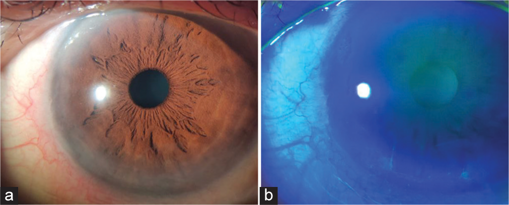 After 2 weeks of treatment of topical 5-fluorouracil, (a) Lesion on the cornea barely visible. (b) Cornea still with areas of dye uptake inferiorly.