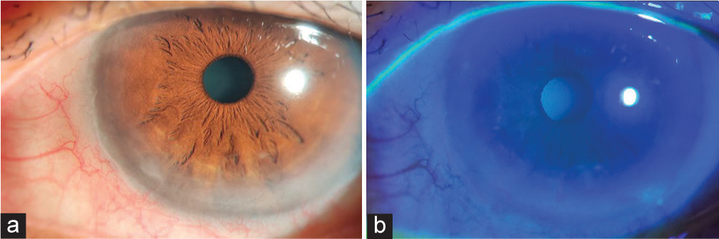 After completion of 1 cycle of treatment. (a) lesion on the cornea barely visible on slit-lamp examination. (b) No epithelial lesion was seen on the cornea and no dye uptake with fluorescein.