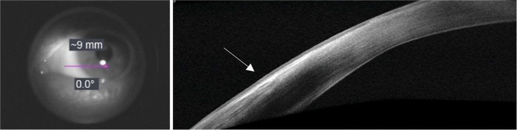 After completion of 1 cycle of treatment, en face projection of OCT signal from conjunctiva to cornea (pink arrow). Anterior segment OCT still with an area of hyperreflectivity on the conjunctiva (white arrow).