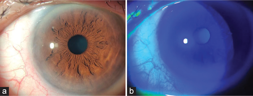 After completion of 2 cycles of treatment, (a) Clear cornea with no epithelial defect seen (b) no dye uptake on fluorescein staining.