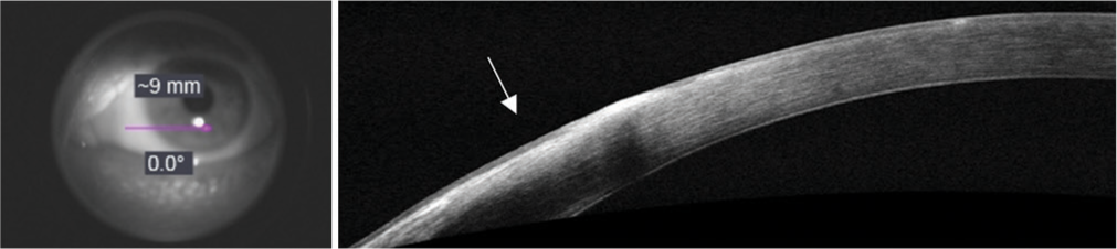 After completion of two cycles of treatment, en face projection of OCT signal from conjunctiva to cornea (pink arrow). Anterior segment OCT still with an area of minimal hyperreflectivity on the conjunctiva (white arrow).