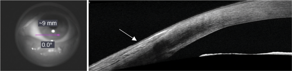 After completion of three cycle of treatment, en face projection of OCT signal from conjunctiva to cornea (pink arrow). Anterior segment OCT still with an area of minimal hyperreflectivity on the conjunctiva (white arrow).