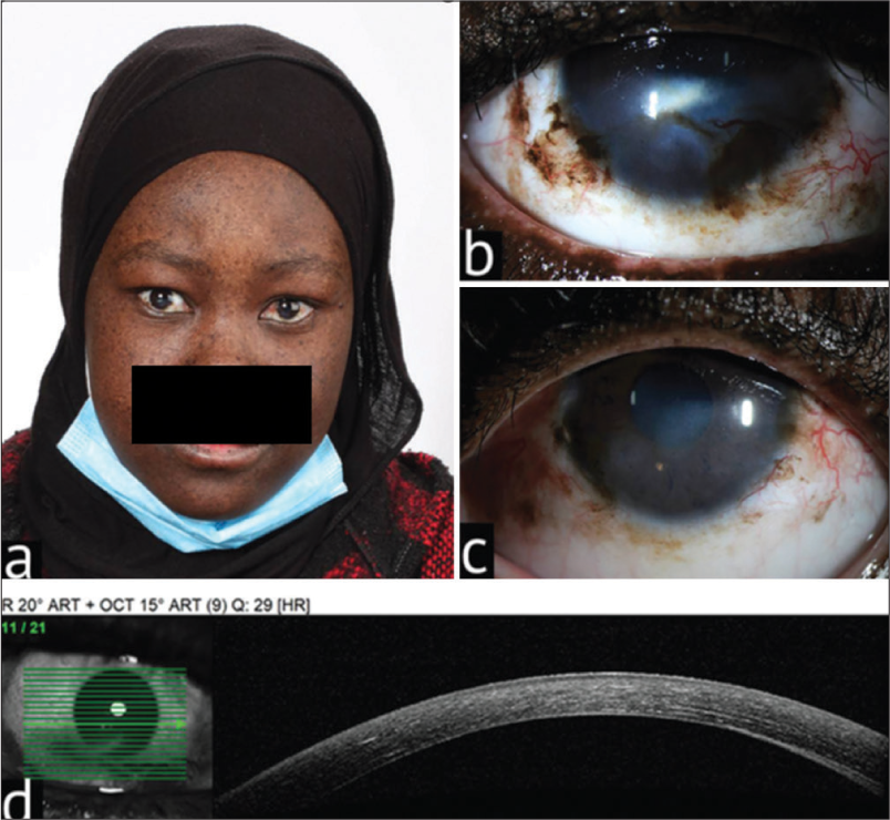 (a) A 15-year-old xeroderma pigmentosa patient with hyperpigmented macules. (b) External slit lamp photograph with inferior stromal scarring along with a feeder vessel in the right eye. (c) External slit lamp photograph with similar findings in the left eye. (d) Anterior segment optical coherence tomography photograph of the right eye with normal epithelium and hyperreflectivity of the anterior stroma.