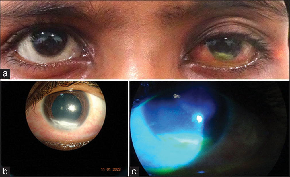 A 13-year-old girl with carcinoma nasopharynx (a) Front view showing left eye corneal infiltration with mild redness. (b) Slit-lamp picture of the cornea shows infiltration. (c) Fluorescein stain positive lesion.