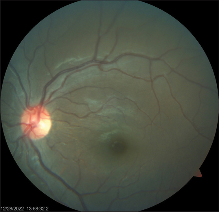 Left optic disc photograph showing temporal pallor.