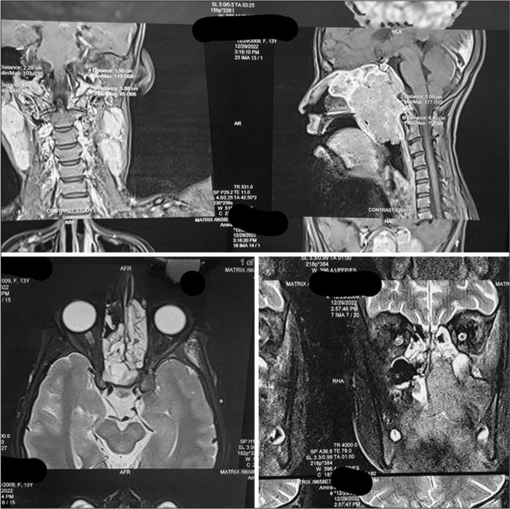 Collage of MRI Scans showing extent of locoregional spread of nasopharyngeal carcinoma.