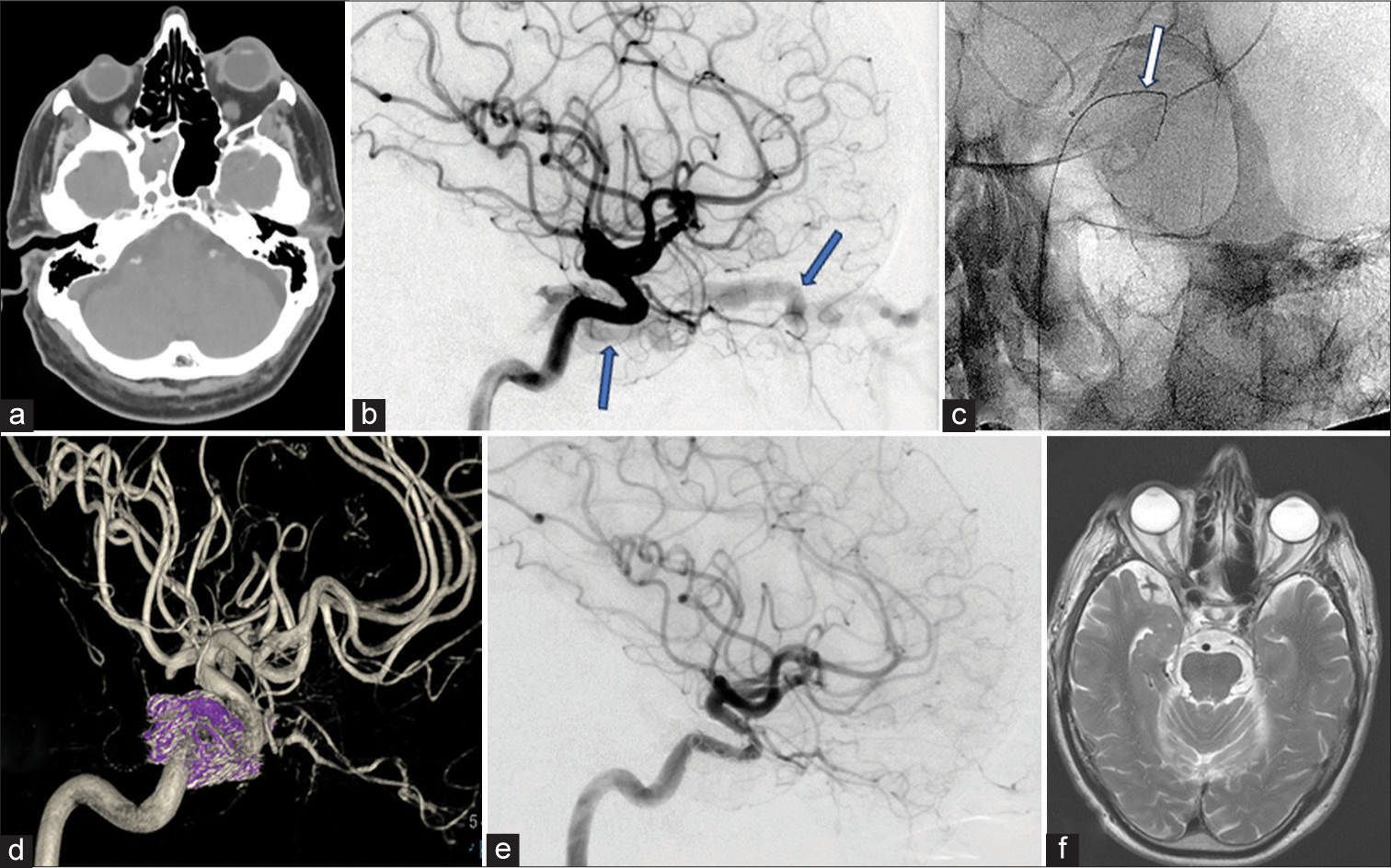 Caroticocavernous fistula (CCF) pre- and post-endovascular treatment. (a) Computed tomography of the head showing left-sided proptosis. (b) Left internal carotid angiogram (lateral view) showing early filling of contrast in the left cavernous sinus and a dilated left superior ophthalmic vein (SOV), both indicated by blue arrows, in keeping with an underlying fistula. (c) Wire (white arrow) in the left SOV introduced externally to access the cavernous sinus. Access to the sinus through the internal jugular vein/inferior petrosal sinus was not possible in this case. Cannulation of SOV was performed by an ophthalmic surgeon by skin crease incision and open cut down. (d) Post-treatment left internal carotid angiogram (3-D spin reformat) showing occlusion of CCF with coils (in purple) in the cavernous sinus. (e) Left internal carotid artery angiogram (lateral view) post-treatment. The early filling of the cavernous sinus and SOV present previously (cf. B) is no longer seen, indicating occlusion of the fistula. (f) Magnetic resonance imaging of the head after about six months shows complete resolution of the left proptosis.