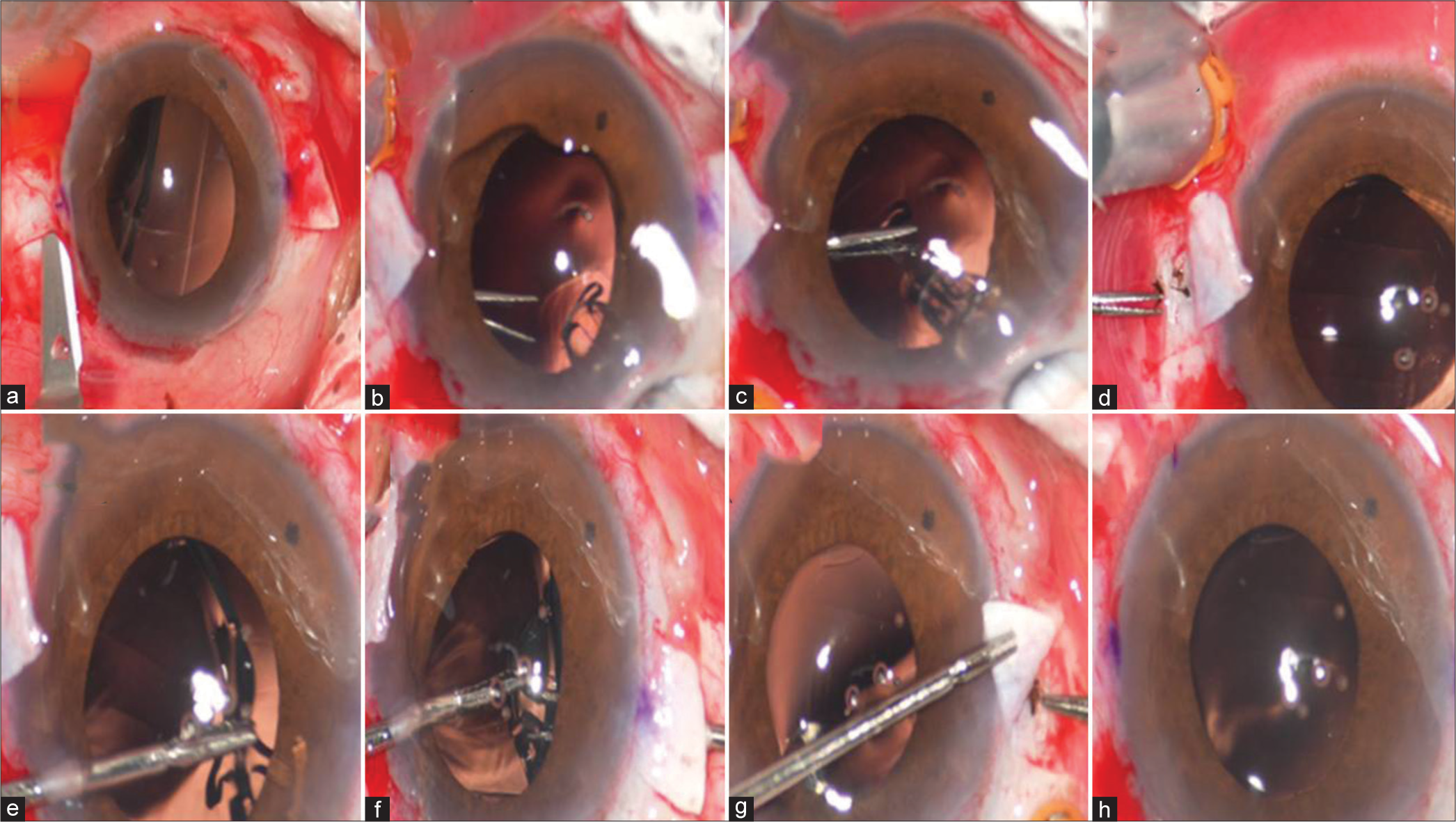 (a) Creation of scleral flap, (b) Insertion of IOL, (c) Grasping the neck of “T” shape haptic, (d) Explantation of the leading haptic through the sclerotomy, (e-g) Using handshake technique at the other end of the haptic grasped, (h) explantation of the trailing haptic through second sclerotomy site.