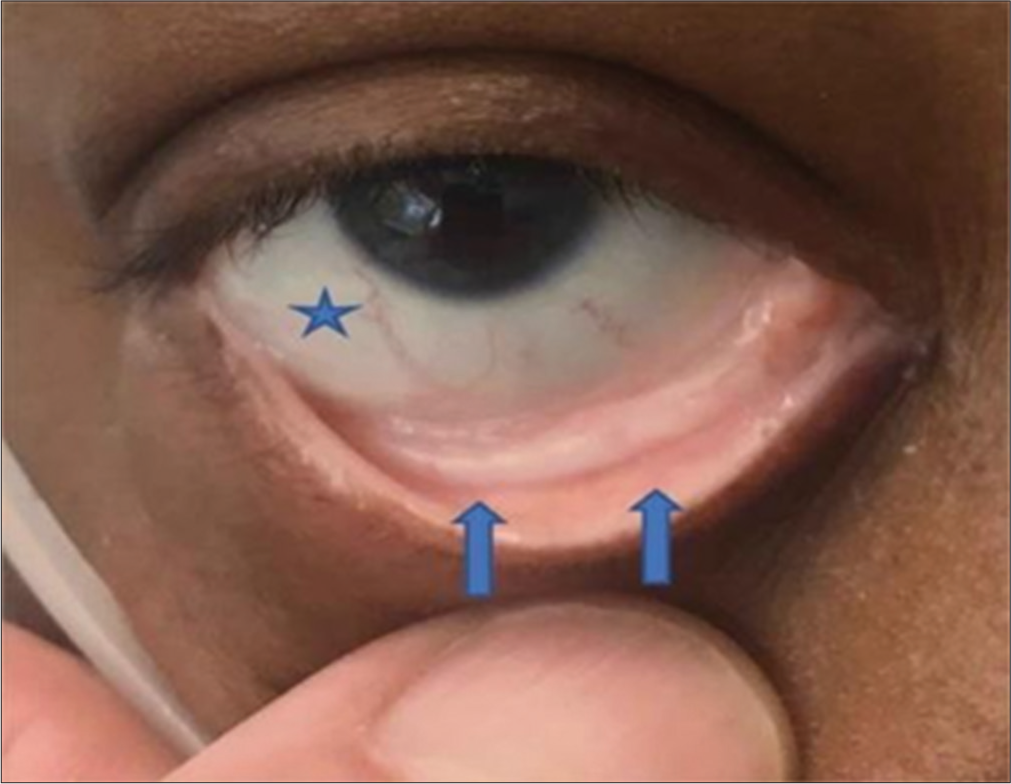 Conjunctival pallor (arrows and star).