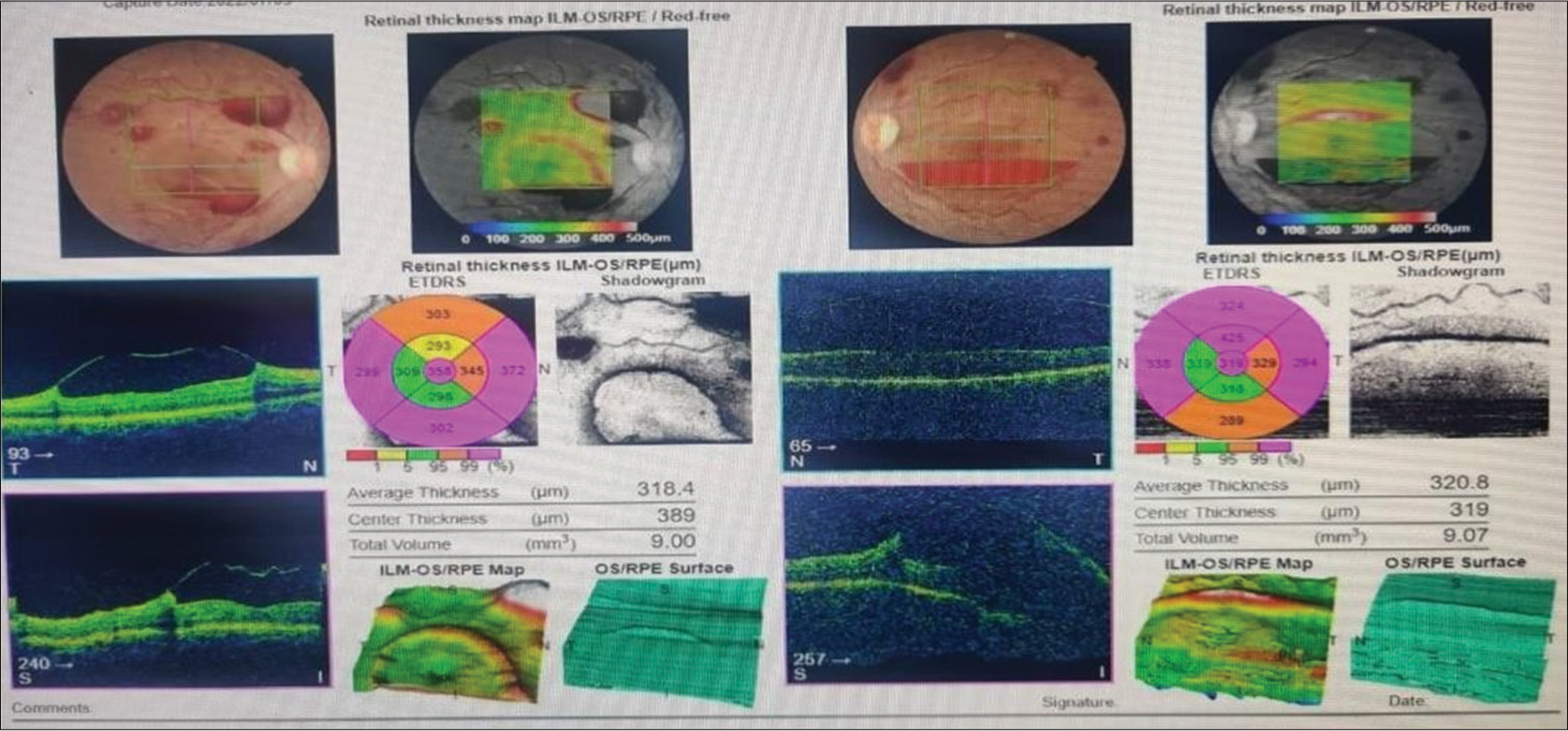 Fundus photography and optical coherence tomography at the time of presentation.