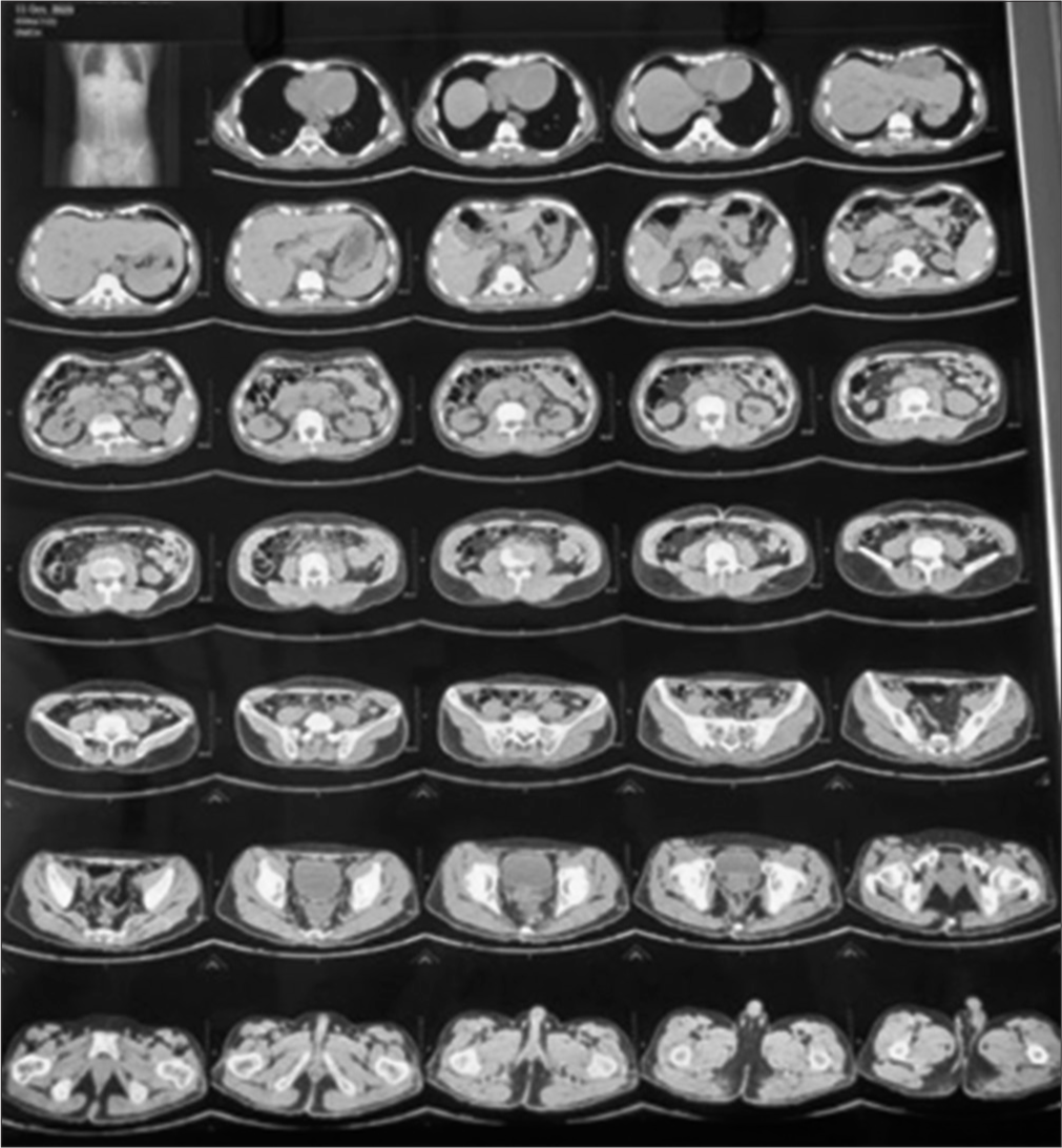 Contrast-enhanced computed tomography abdomen flim.