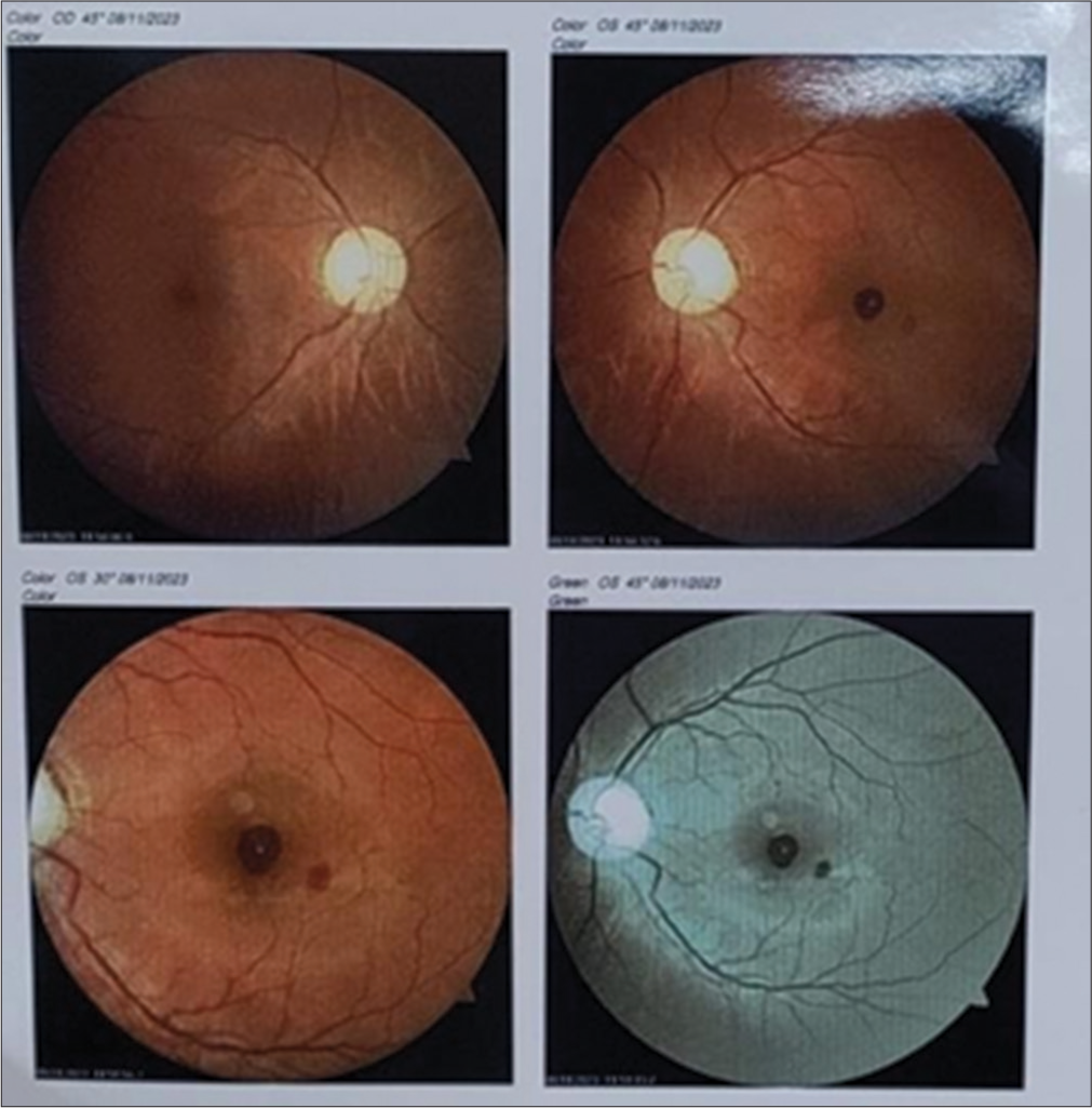 Fundus picture of the patient after 10 weeks of treatment.