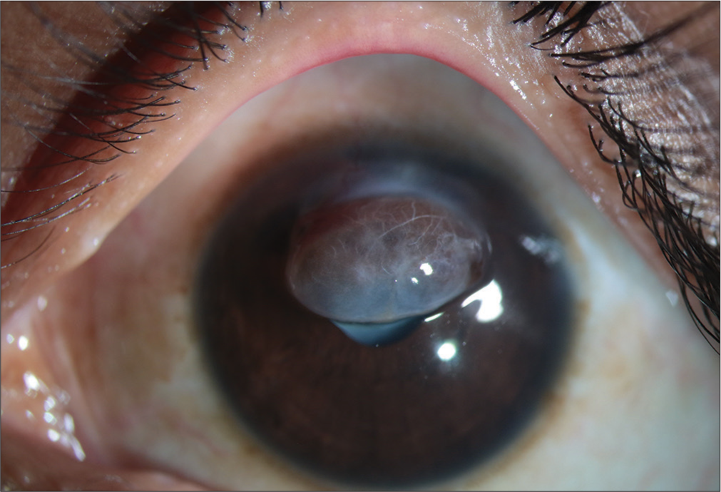 Slit-lamp image showing a large central descemetocele with encysted iris tissue and traumatic cataract.